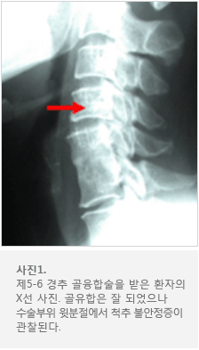 목디스크란